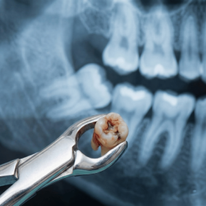Wisdom Teeth Removal - Painless Extraction